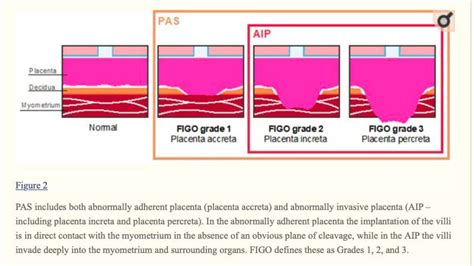 Placenta Accreta Spectrum | PPTX