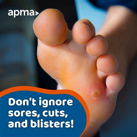 Painful Yellow Bump On Bottom Of Foot Clearance | emergencydentistry.com