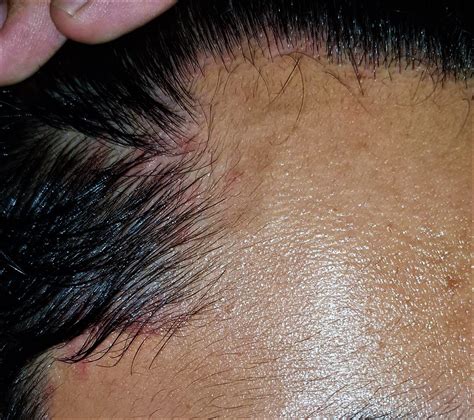 Seborrheic Dermatitis | Treatment & Management | Point of Care