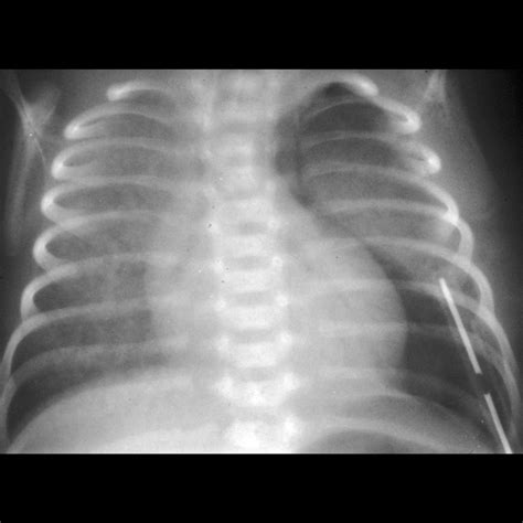 Infant Pneumothorax X Ray