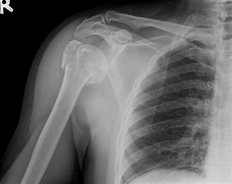 Left Humerus Fracture