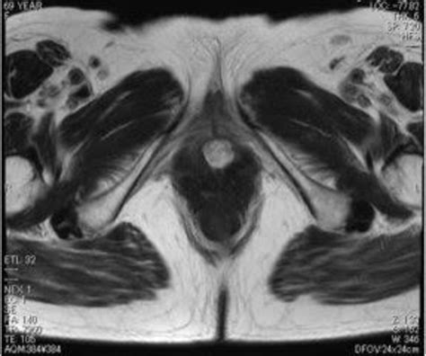 Urinary tract bleeding from a urethral caruncle mimicking genital tract ...