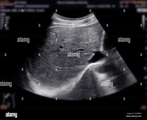 A normal ultrasound of the upper abdomen, showing healthy organs with no abnormalities. Clear ...