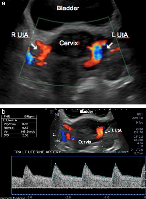 Transverse technique: complementary approach to measurement of first‐trimester uterine artery ...
