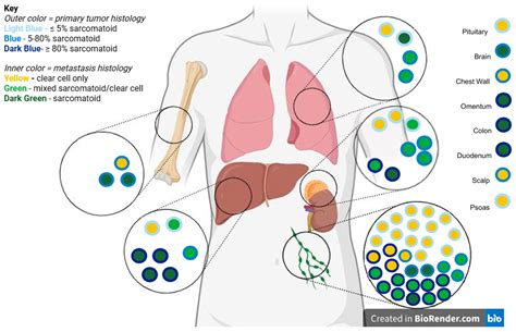 Histologic Heterogeneity of Metastases in Clear Cell Renal Cell ...