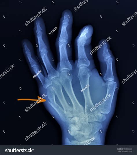 On X-ray Hand Fracture Fifth Metacarpal Stock Photo 1543043888 | Shutterstock
