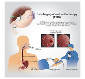 Image result for EDG Procedures