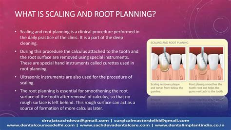 Scaling and root planning | Periodontal treatment protocol | Treatment of Gum Disease ...