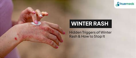 Winter Rash: Causes, Symptoms, and Remedies for Dry, Itchy Skin