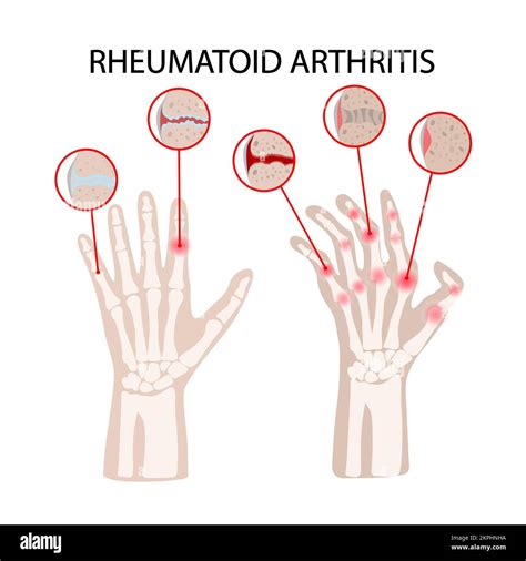 RHEUMATOID ARTHRITIS DISEASE Focal Lesions Of The Hands Chronic Illness Medicine Education ...