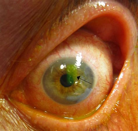 Recurrent Corneal Erosion (RCE) | Canadian Association of Optometrists