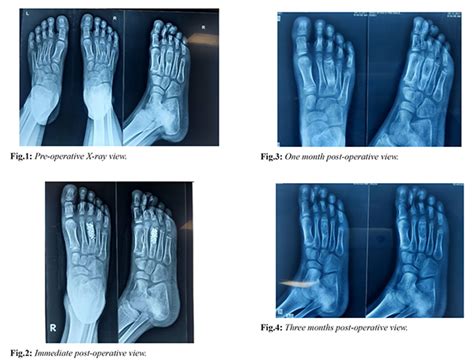 Aneurysmal Bone Cyst of Third Metatarsal in a Young Child