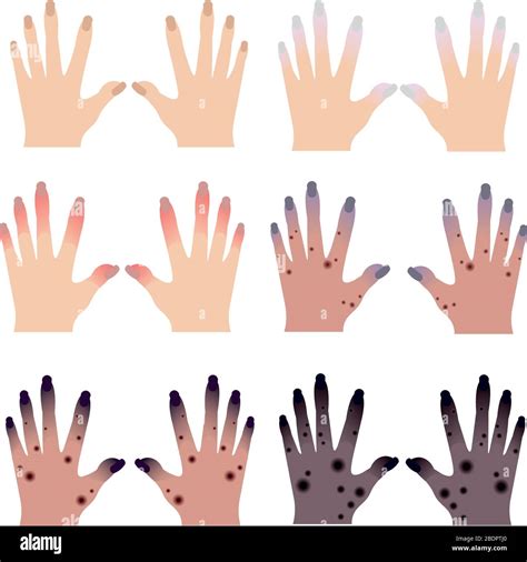 Gangrene hi-res stock photography and images - Alamy