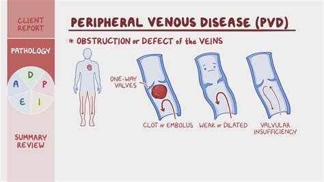 Peripheral Neuropathy Venous Insufficiency at Imogen Webb blog
