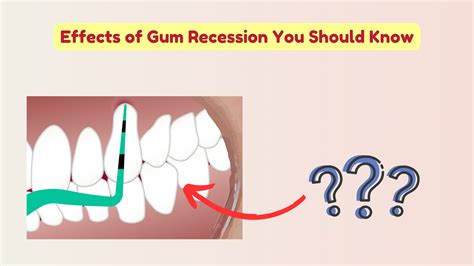 4 Common Things That Happen When Gums Start to Recede