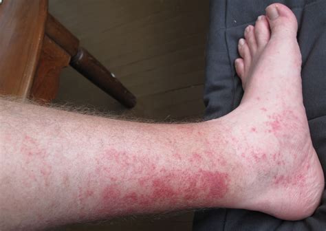 Itchy Ankles Sock Line at Howard Vasquez blog