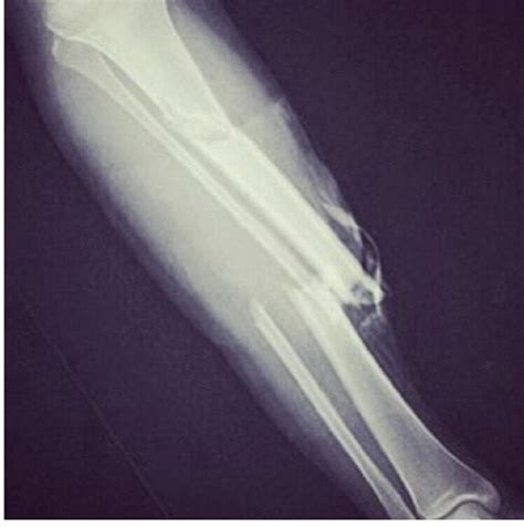 Kevin Ware Injury X Ray