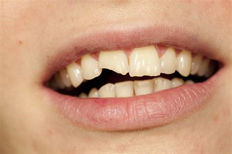 Cracked Or Chipped Front Tooth? What Can You Do?