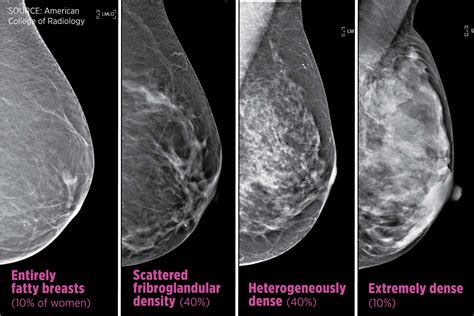 Normal Mammogram With Density
