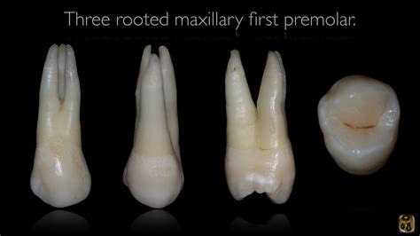 Maxillary 1st Premolar