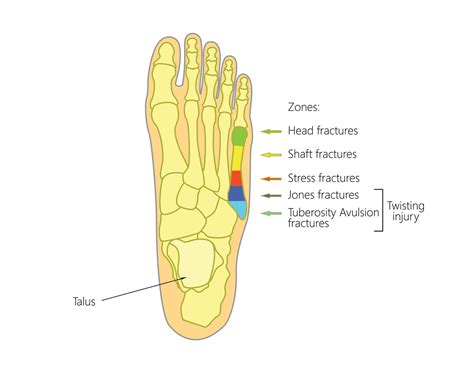 5Th Metatarsal Base