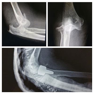 Terrible triad with radial head replacement and LCL reconstruction
