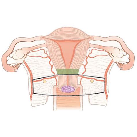 Trachelectomy After Supracervical Hysterectomy: A Case Study