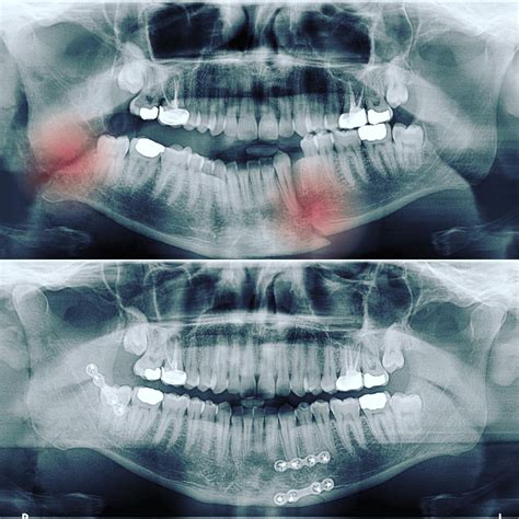 Facial Trauma Surgery — Dr Anthony Chellappah | Northern Beaches Sydney | Oral and Maxillofacial ...