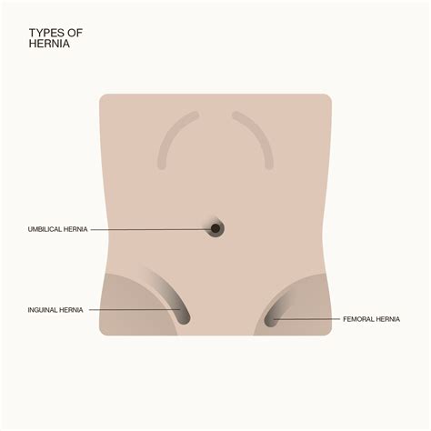 Femoral Hernia Types