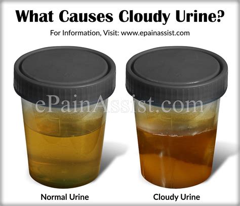 What Causes Cloudy Urine & 12 Home Remedies To Get Rid of It