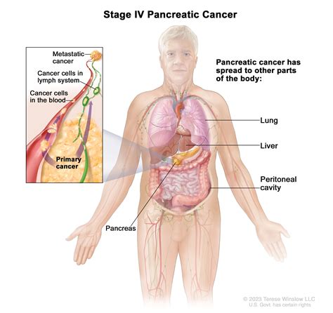 Types Of Pancreatic Cancer What Makes A Pancreatic Cancer Resectable?