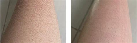Daily Repair Body Oil for Psoriasis Scars and Marks (100 ml) – Oleum ...