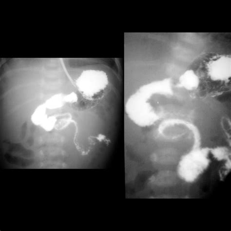Newborn with bilious vomiting | Pediatric Radiology Case | Pediatric ...