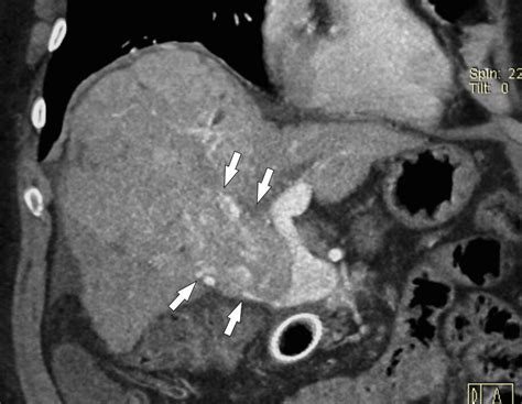 Pfortaderthrombose: Risikofaktoren, bildgebende Diagnostik, Komplikati ...