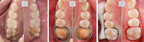 MIH Teeth Treatment: CEREC Tessera Restoration | Dentsply Sirona IN