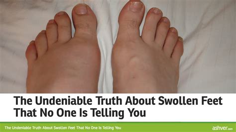 The Undeniable Truth About Swollen Feet That No One Is Telling You ...