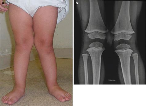 Common Orthopedic Problems in Children | Musculoskeletal Key