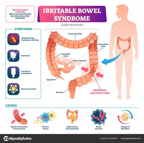 Irritable bowel syndrome vector illustration. Labeled medical disease graph Stock Vector Image ...