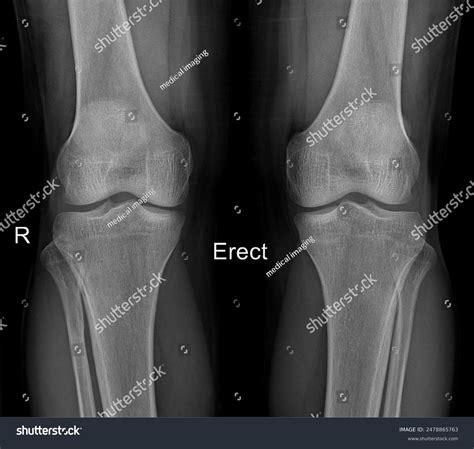 Standing Bilateral Knee X-rays Clinical Assessment Stock Photo ...