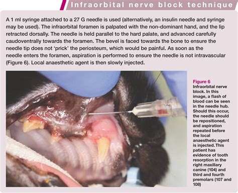 Maxillary Nerve Block Technique