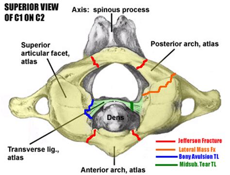 Atlas Fractures & Transverse Ligament Injuries - Spine - Orthobullets