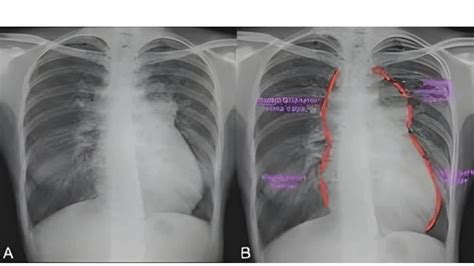 Total Anomalous Pulmonary Venous Return (TAPVR) overview
