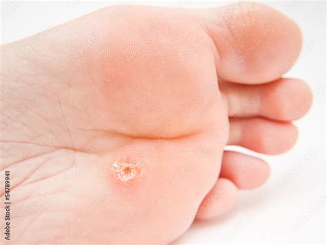 Corn Bandage- How Effective it is on Foot Corn – Drfootin