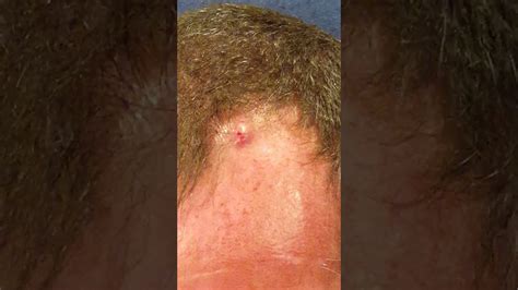 Image result for Exploding Chunky Cyst