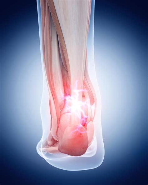 Achilles Tendinitis Specialist - Palm Harbor, FL: Orthopedic Specialists: Orthopedic Surgeon