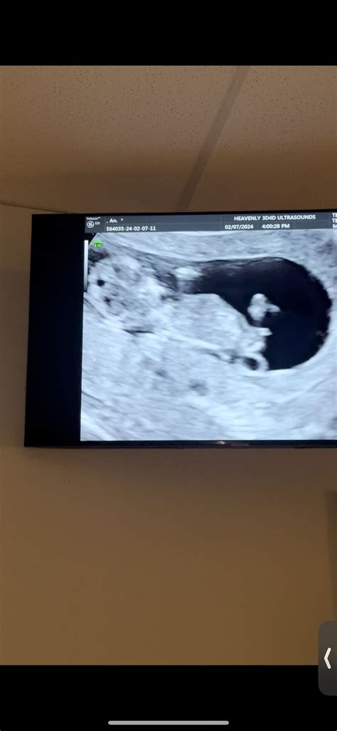 Nub and Skull theory | BabyCenter