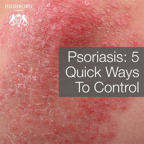5 Quick Fixes To Avoid Psoriasis Flare-Ups – HighBorn London