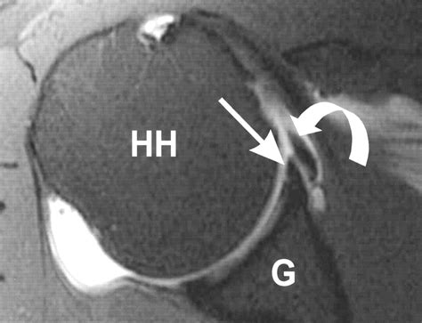 Superior Labral Anteroposterior Tear: Classification and Diagnosis on MRI and MR Arthrography | AJR