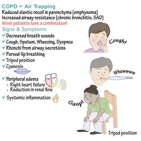 CHRONIC OBSTRUCTIVE PULMONARY DISEASE,WHAT TO KNOW?