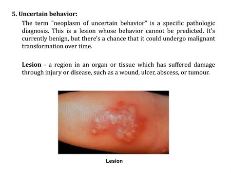 Neoplasm icd 10 guideline | PPTX